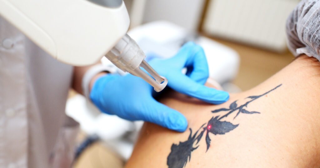 Resultados reales en eliminación de tatuajes con Picosegundo